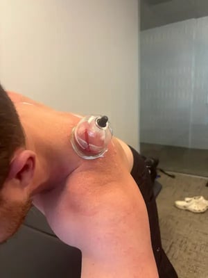 Athlete using cupping during a recovery session with pro athlete physical therapy Athlete using cupping during a recovery session with pro athlete physical therapy