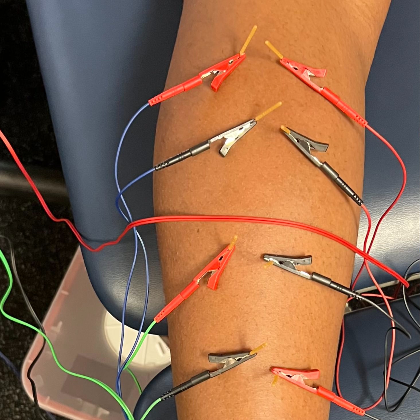 Dry needling an athlete' calf