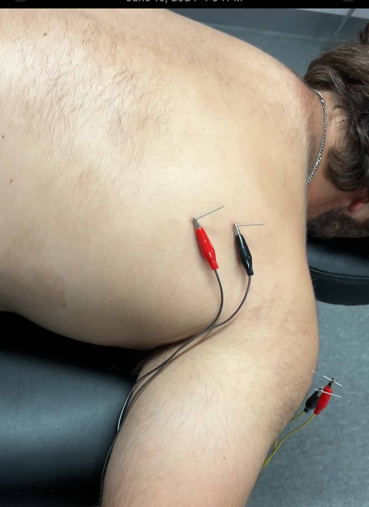 dry-needling-englewood-co