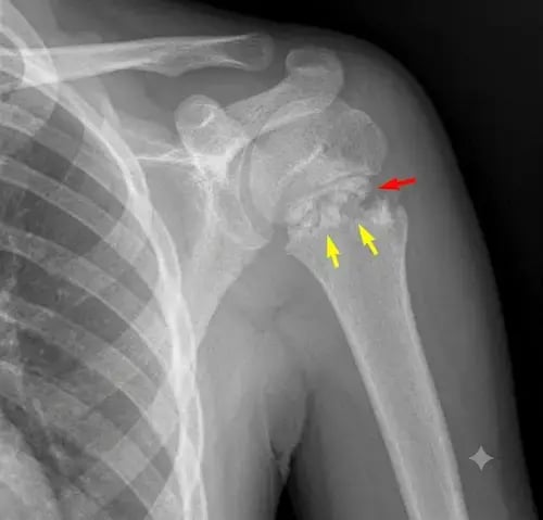 Little league shoulder