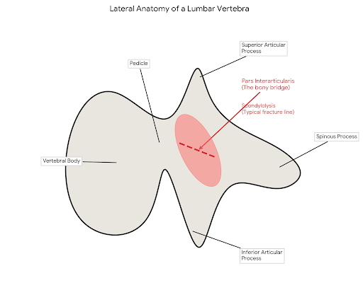 Side view of a pars interarticularis