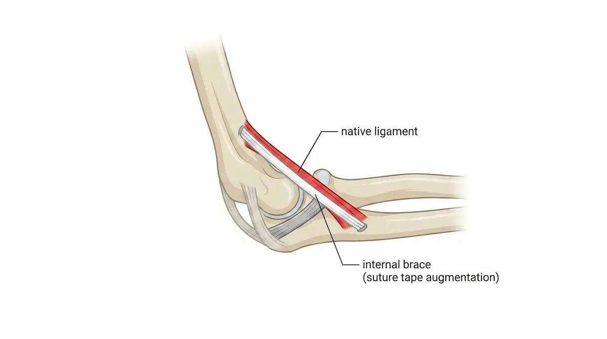 UCL repair with internal brace on the elbow, Tommy John surgery, Lakewood baseball rehab
