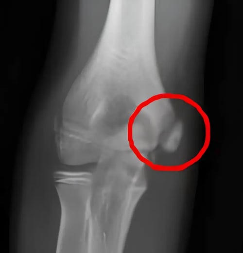 Youth pitcher Little League Elbow x-ray Youth pitcher Little League Elbow x-ray